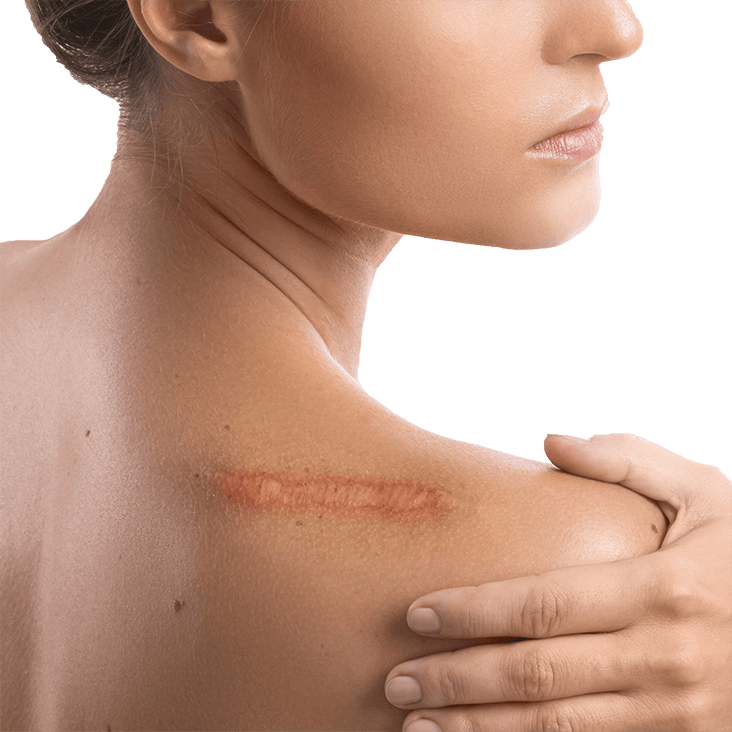 micro needling behandlung