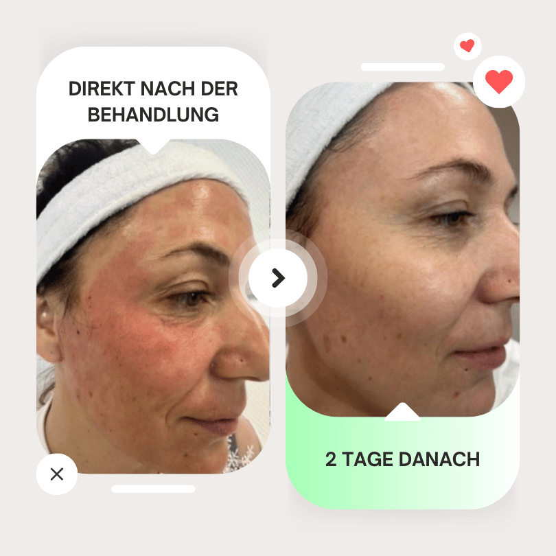 rf microneedling vorher nachher 2 tage