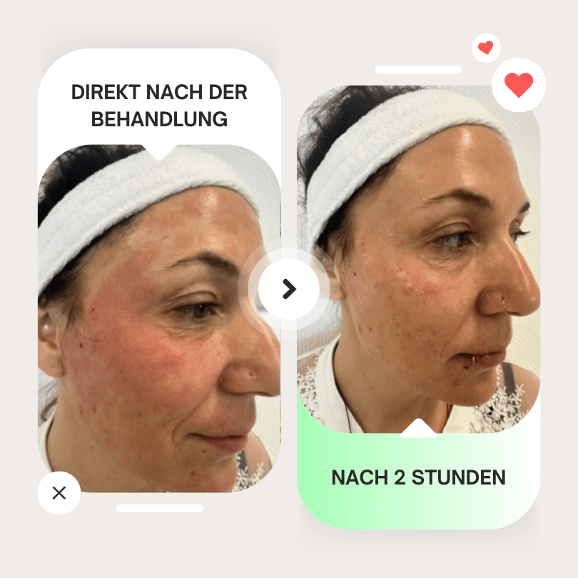 rf microneedling vorher nachher 2 stunden