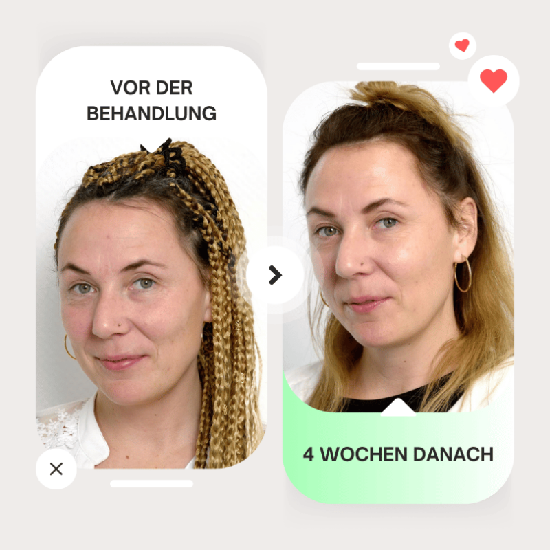 rf microneedling vorher nachher 4 Wochen